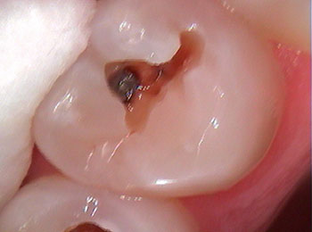 Before decay removal